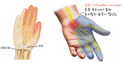 손목터널증후군의 예
